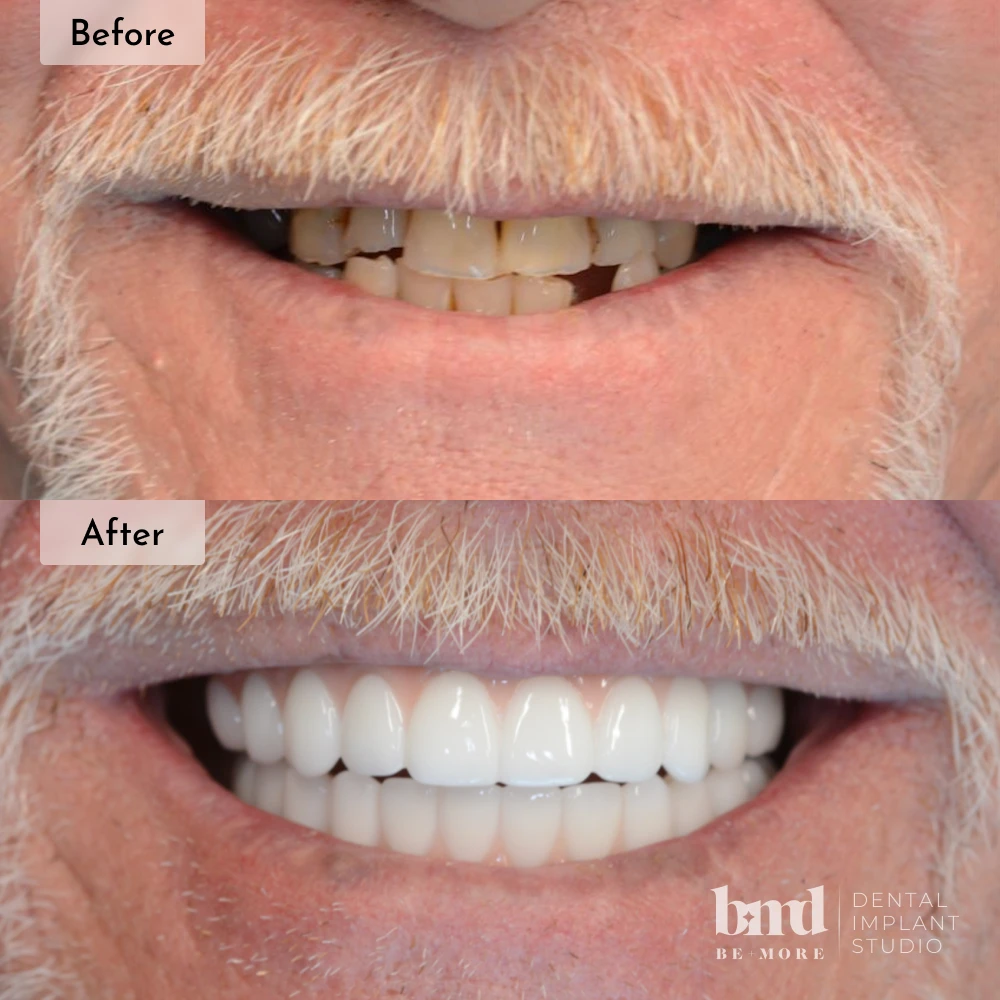 Before and after All-On-4 full mouth dental implants in Baltimore at Be More Dental Implant Studio