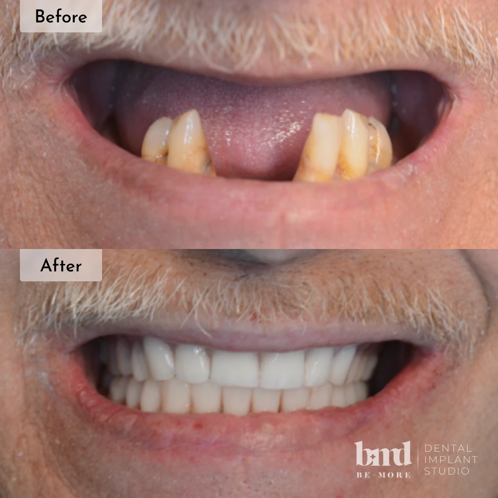 Before and after All-On-4 full mouth dental implants in Baltimore at Be More Dental Implant Studio