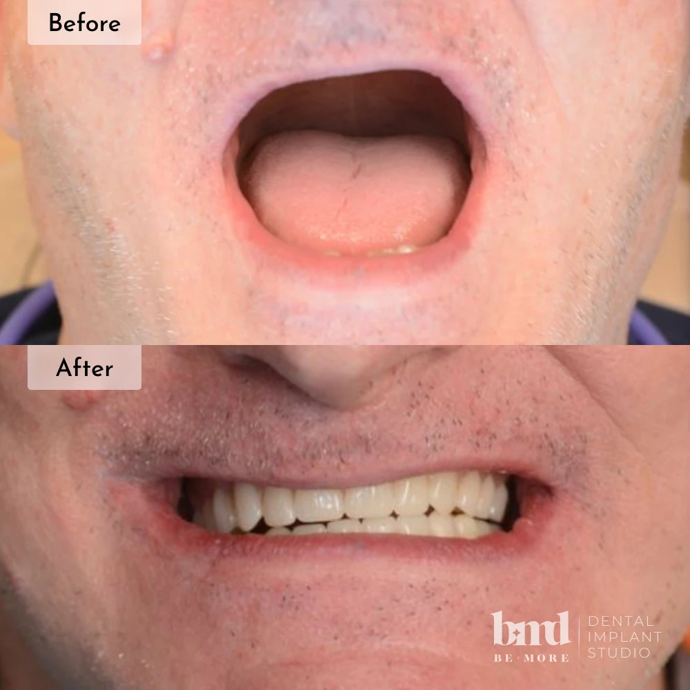 Before and after All-On-4 full mouth dental implants in Baltimore at Be More Dental Implant Studio