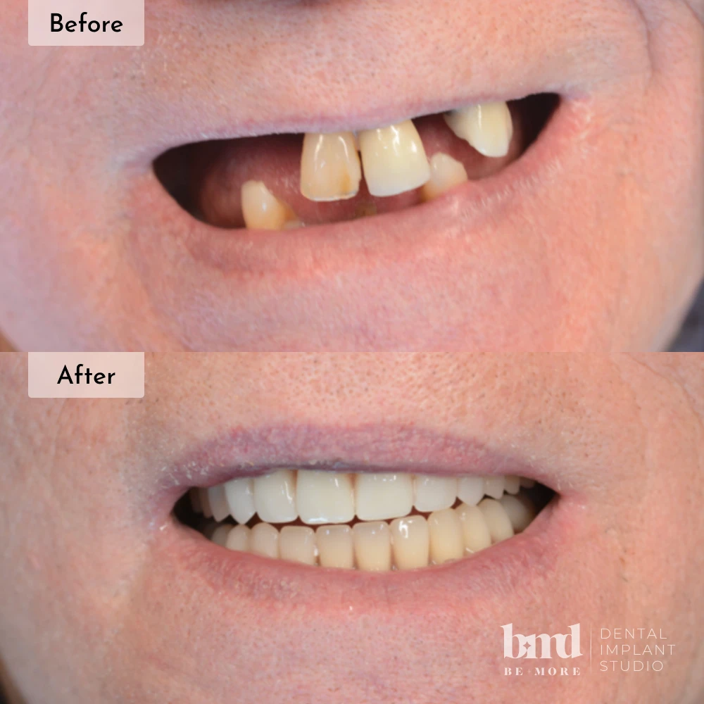 Before and after All-On-4 full mouth dental implants in Baltimore at Be More Dental Implant Studio