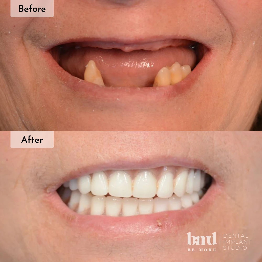 Before and after All-On-4 full mouth dental implants in Baltimore at Be More Dental Implant Studio