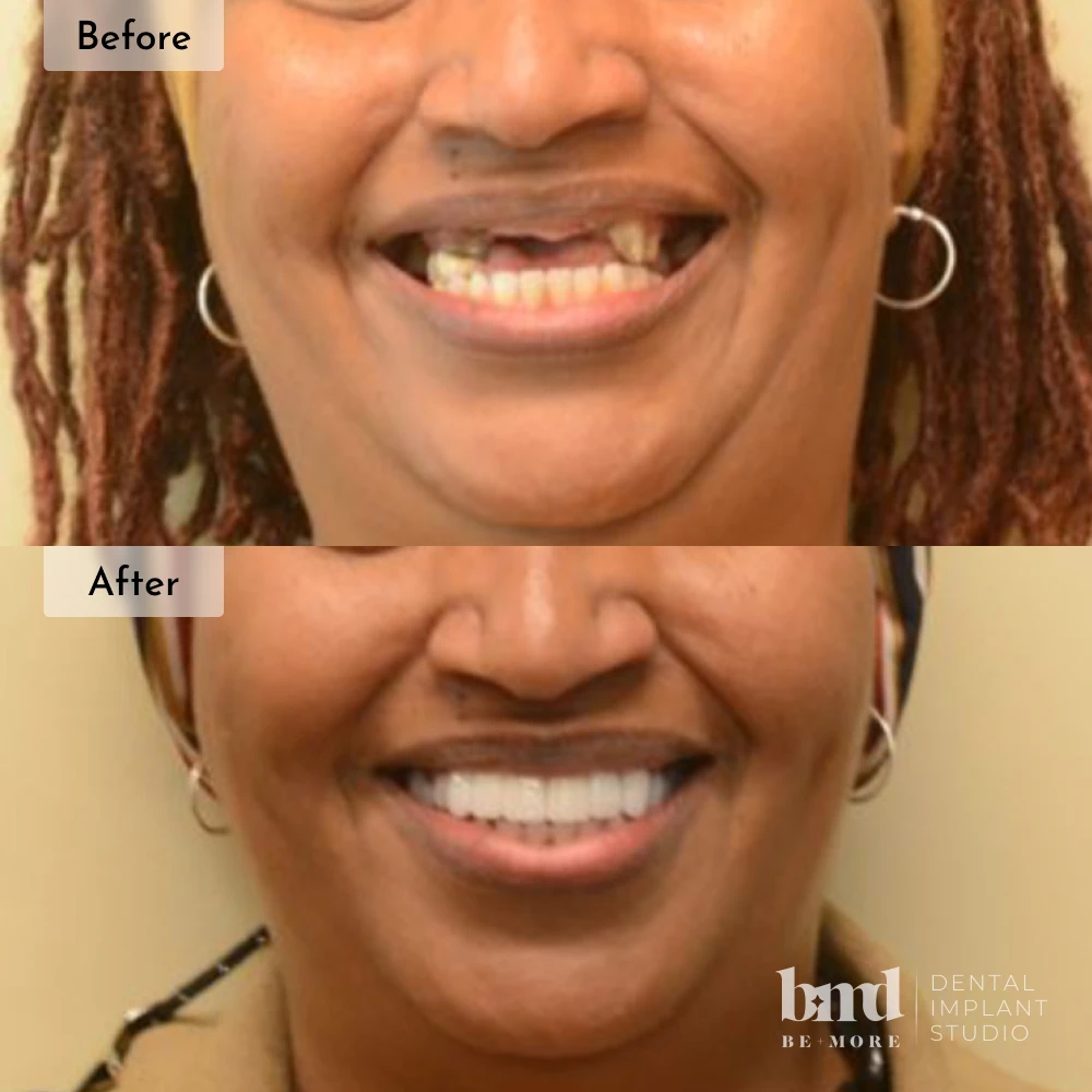 Before and after All-On-4 full mouth dental implants in Baltimore at Be More Dental Implant Studio