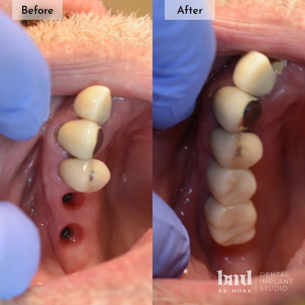 Before and after dental implants in Baltimore at Be More Dental Implant Studio