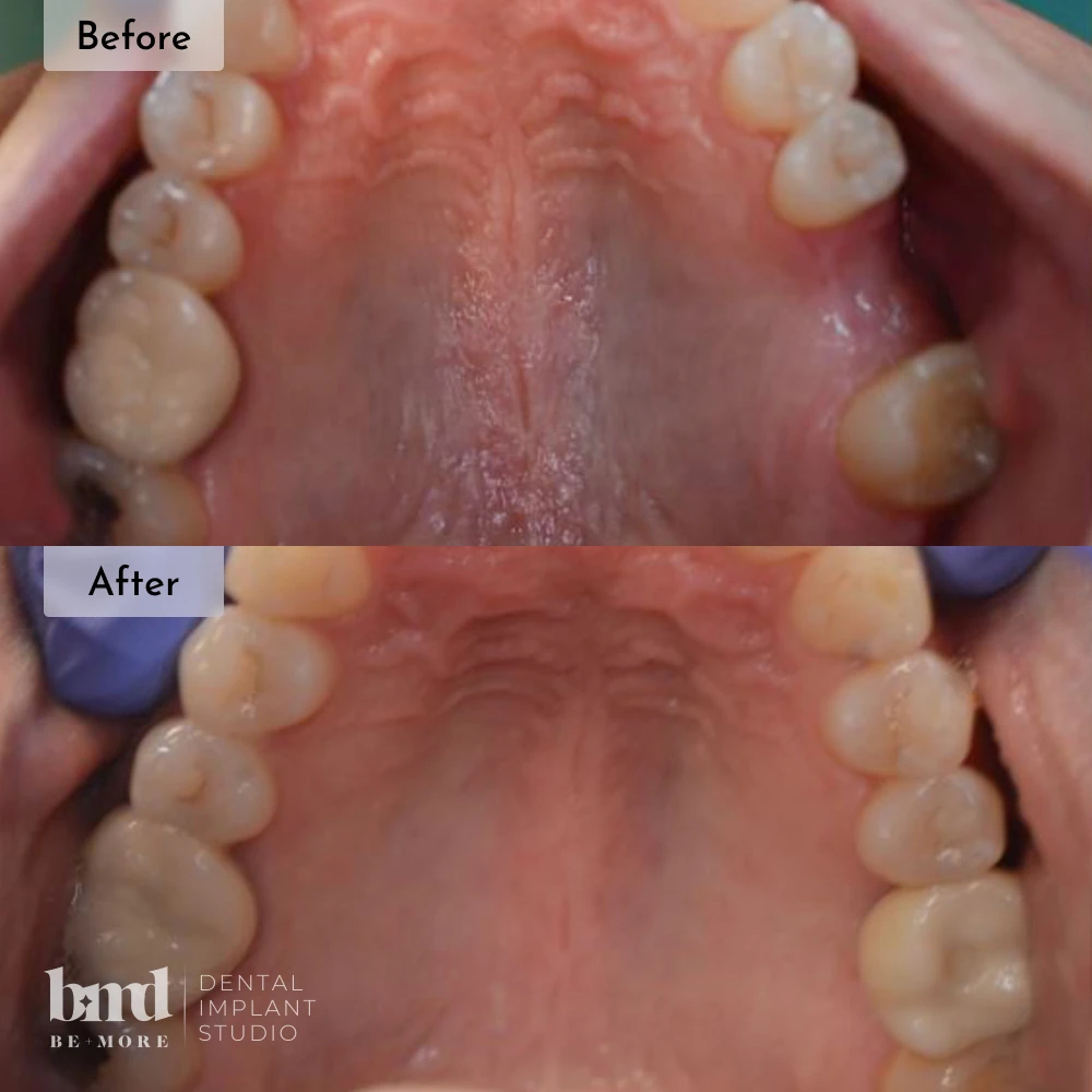 Before and after dental implants in Baltimore at Be More Dental Implant Studio