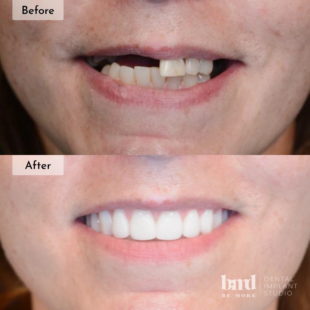 Before and after All-On-4 full mouth dental implants in Baltimore at Be More Dental Implant Studio