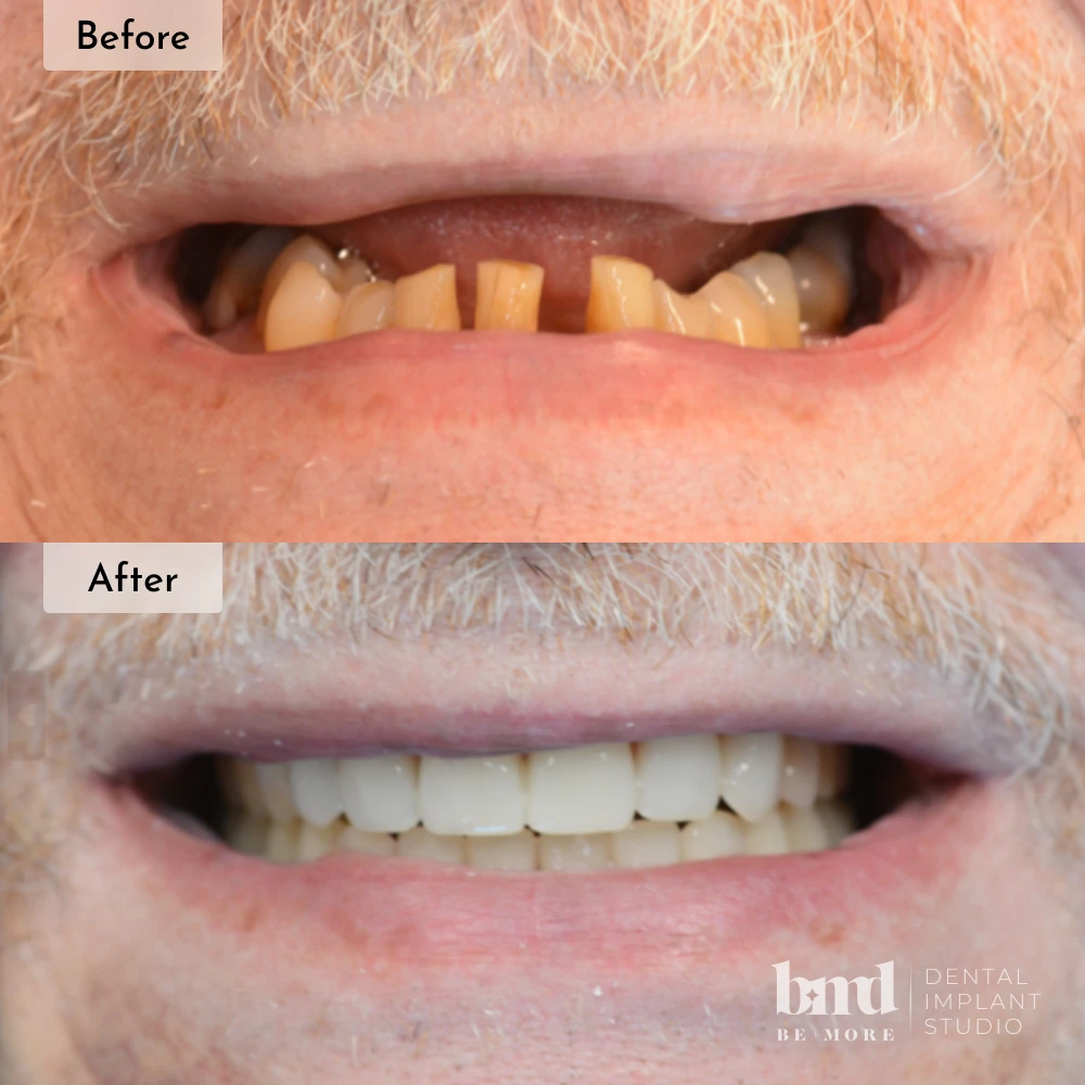 Before and after All-On-4 full mouth dental implants in Baltimore at Be More Dental Implant Studio