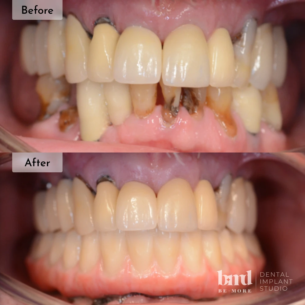 Before and after All-On-4 full mouth dental implants in Baltimore at Be More Dental Implant Studio