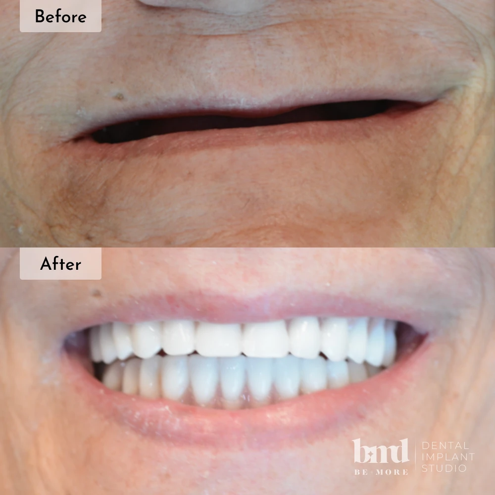 Before and after All-On-4 full mouth dental implants in Baltimore at Be More Dental Implant Studio