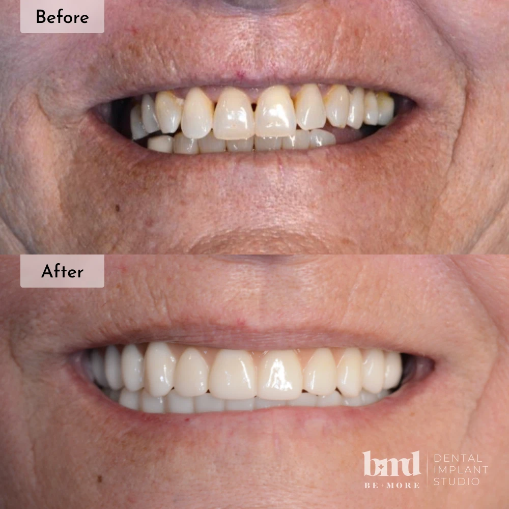 Before and after All-On-4 full mouth dental implants in Baltimore at Be More Dental Implant Studio