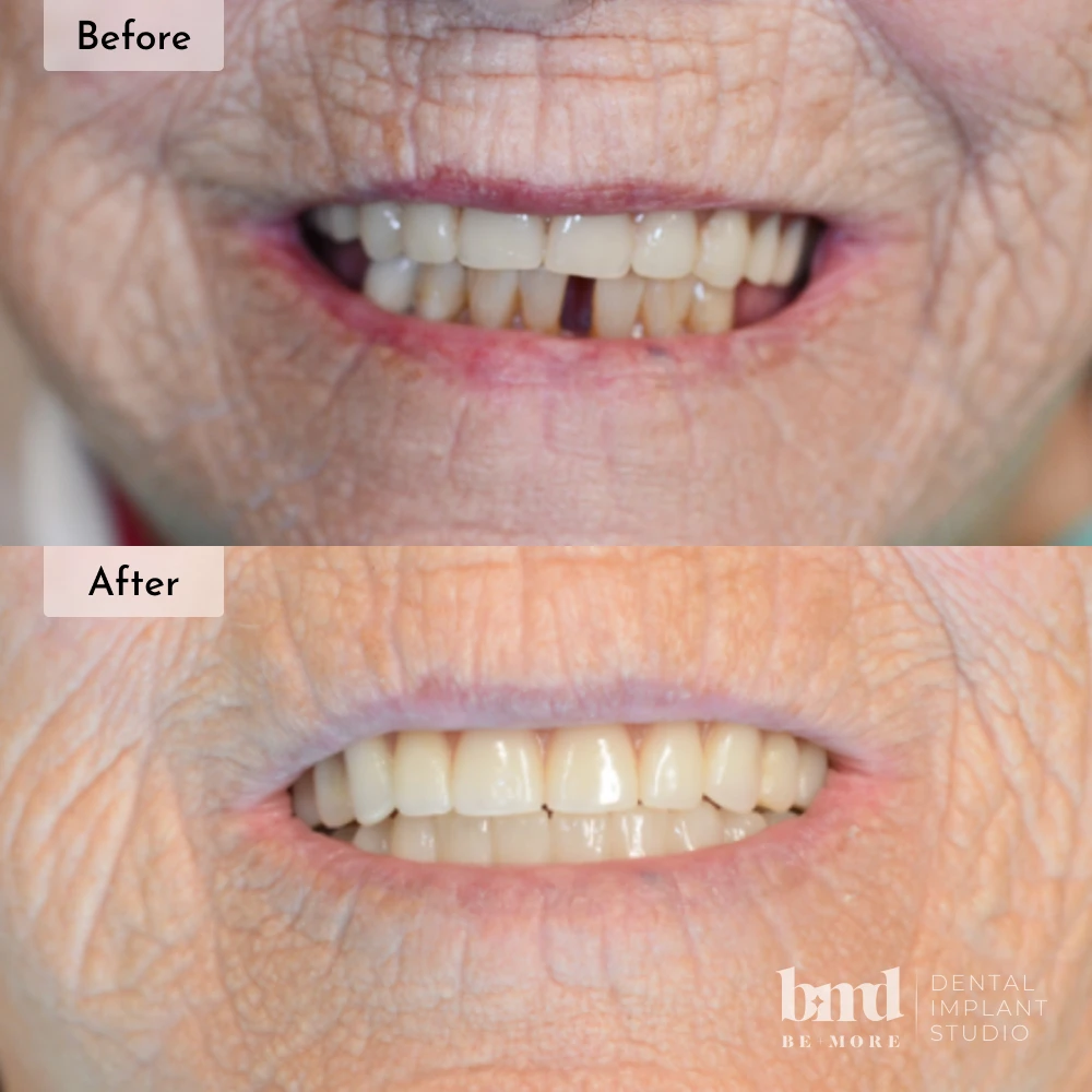 Before and after All-On-4 full mouth dental implants in Baltimore at Be More Dental Implant Studio