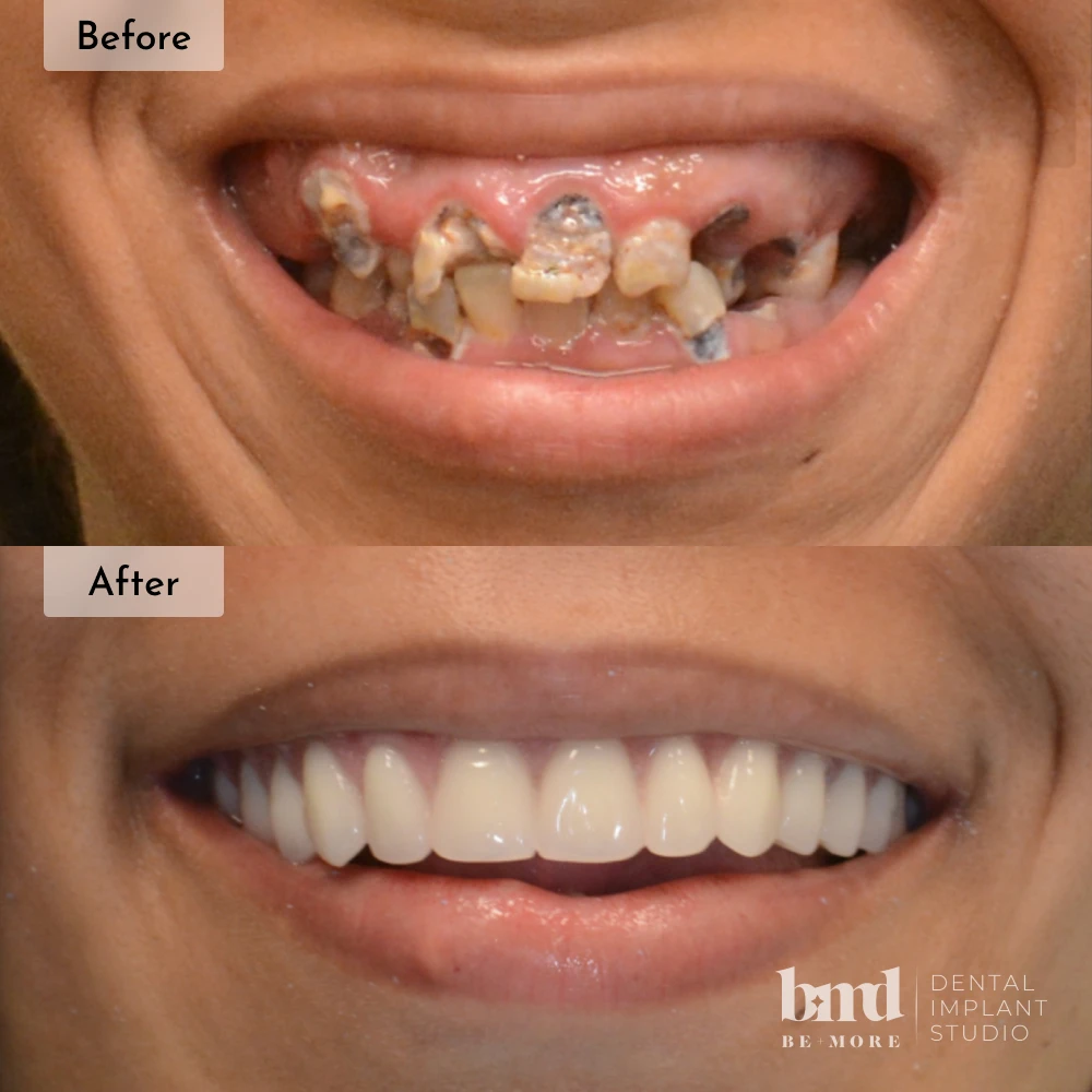 Before and after All-On-4 full mouth dental implants in Baltimore at Be More Dental Implant Studio
