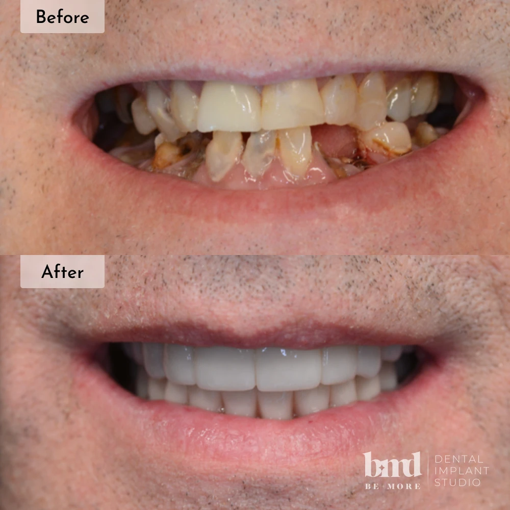 Before and after All-On-4 full mouth dental implants in Baltimore at Be More Dental Implant Studio