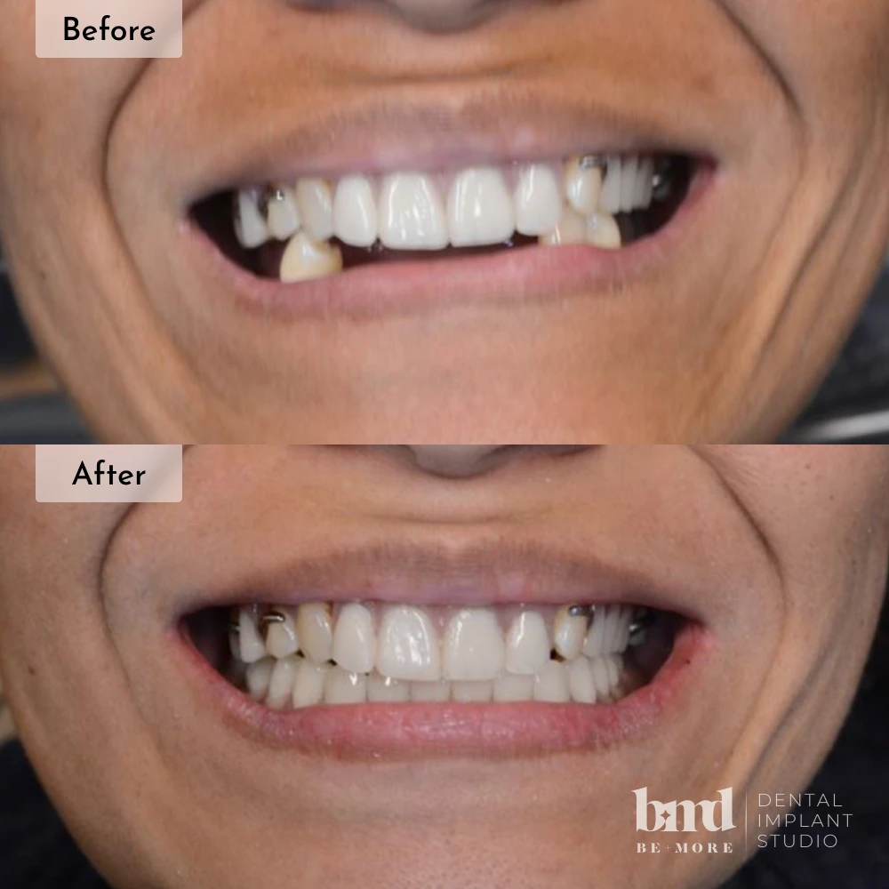Before and after All-On-4 full mouth dental implants in Baltimore at Be More Dental Implant Studio