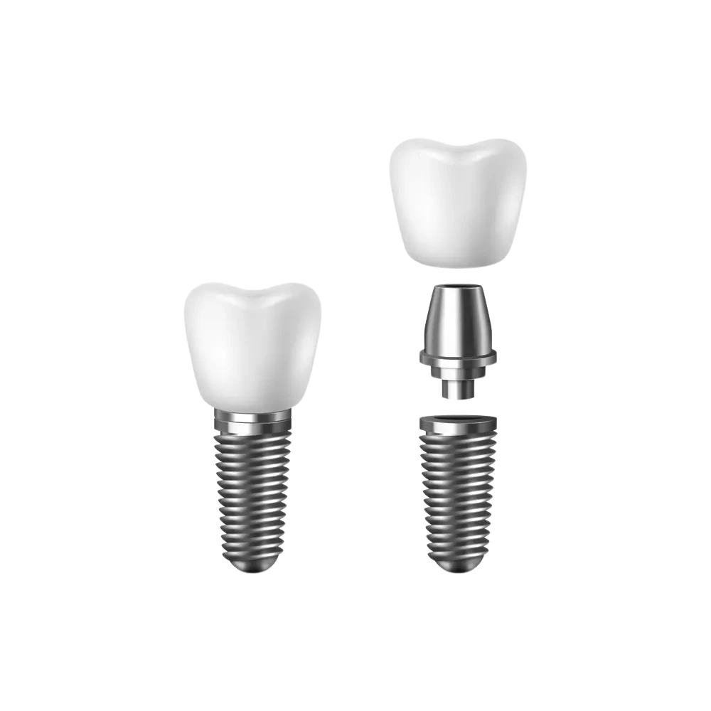 single tooth dental implant model