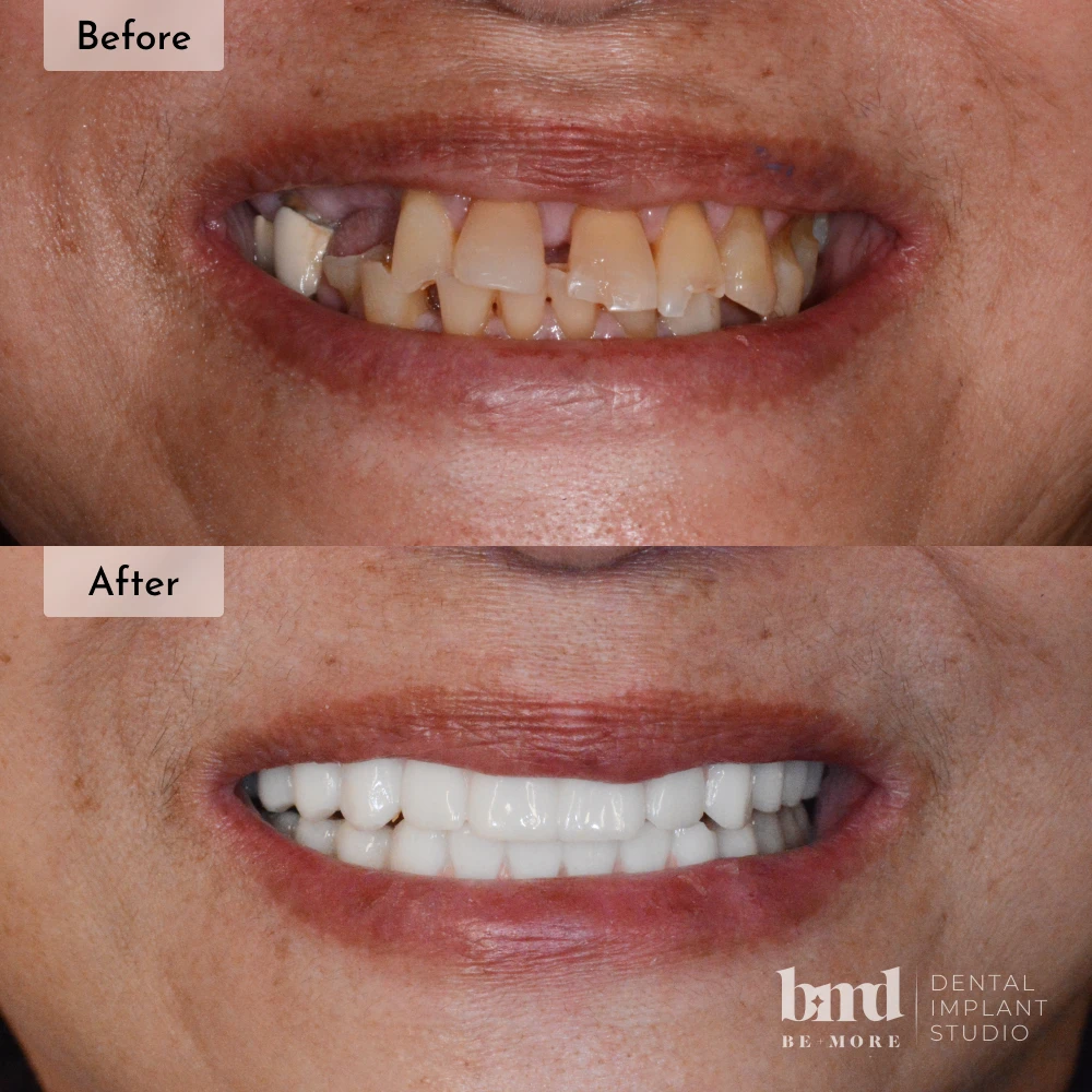 Before and after All-On-4 full mouth dental implants in Baltimore at Be More Dental Implant Studio