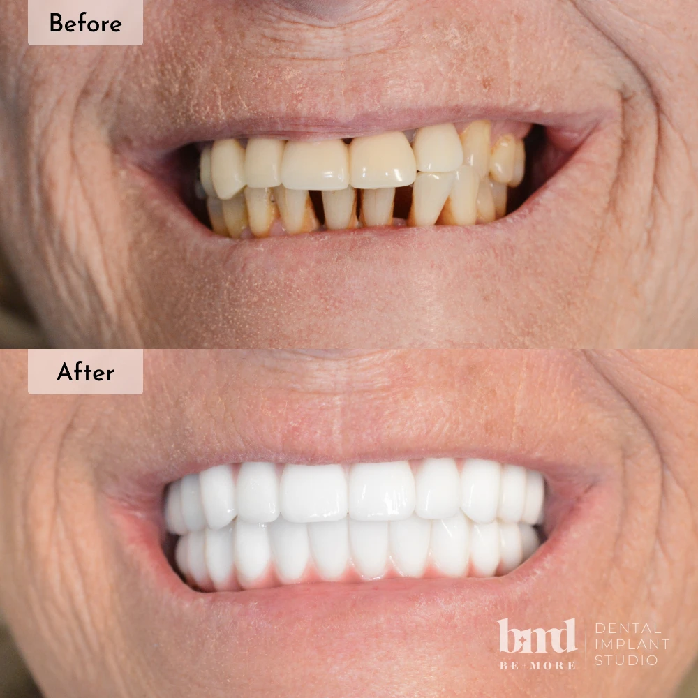 Before and after All-On-4 full mouth dental implants in Baltimore at Be More Dental Implant Studio
