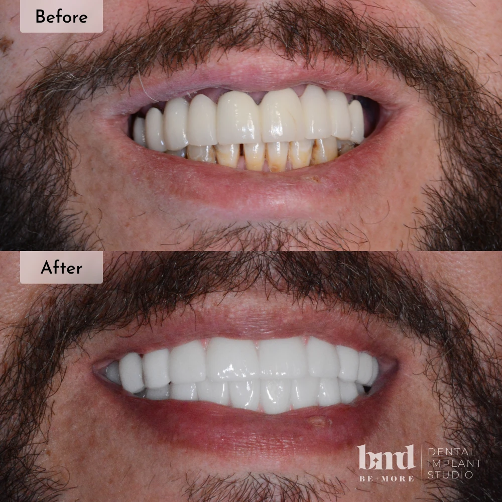 Before and after All-On-4 full mouth dental implants in Baltimore at Be More Dental Implant Studio