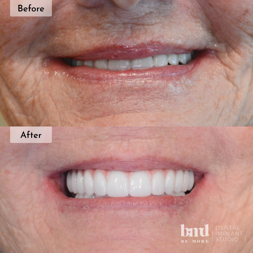 Before and after All-On-4 full mouth dental implants in Baltimore at Be More Dental Implant Studio