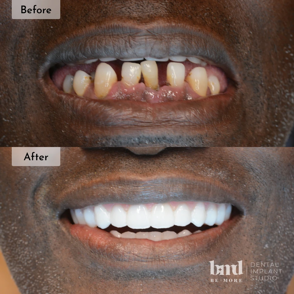 Before and after All-On-4 full mouth dental implants in Baltimore at Be More Dental Implant Studio