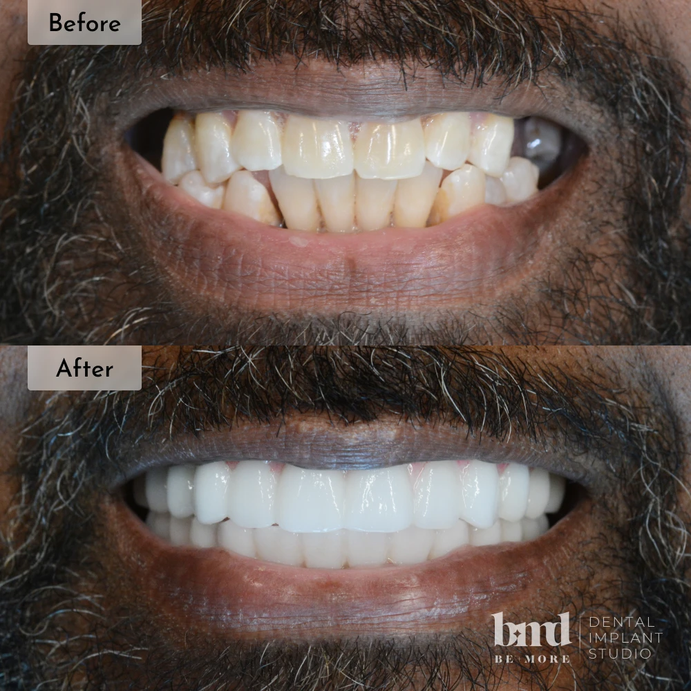 Before and after All-On-4 full mouth dental implants in Baltimore at Be More Dental Implant Studio
