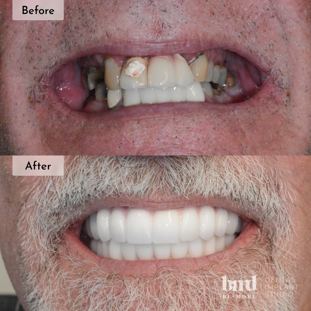 Before and after All-On-4 full mouth dental implants in Baltimore at Be More Dental Implant Studio