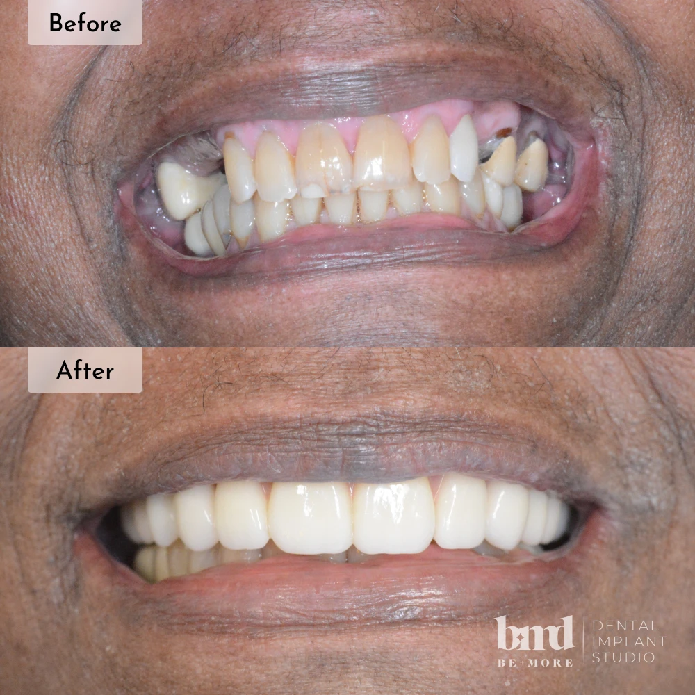 Before and after All-On-4 full mouth dental implants in Baltimore at Be More Dental Implant Studio
