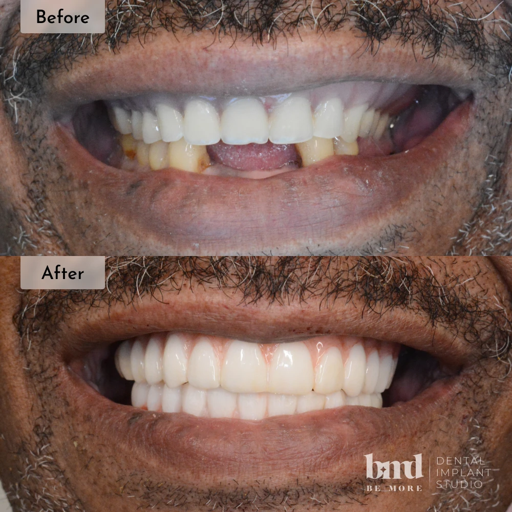 Before and after All-On-4 full mouth dental implants in Baltimore at Be More Dental Implant Studio