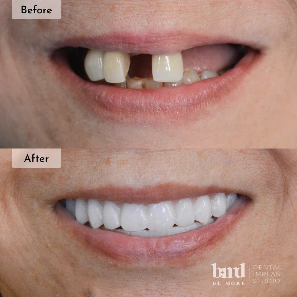 Before and after All-On-4 full mouth dental implants in Baltimore at Be More Dental Implant Studio