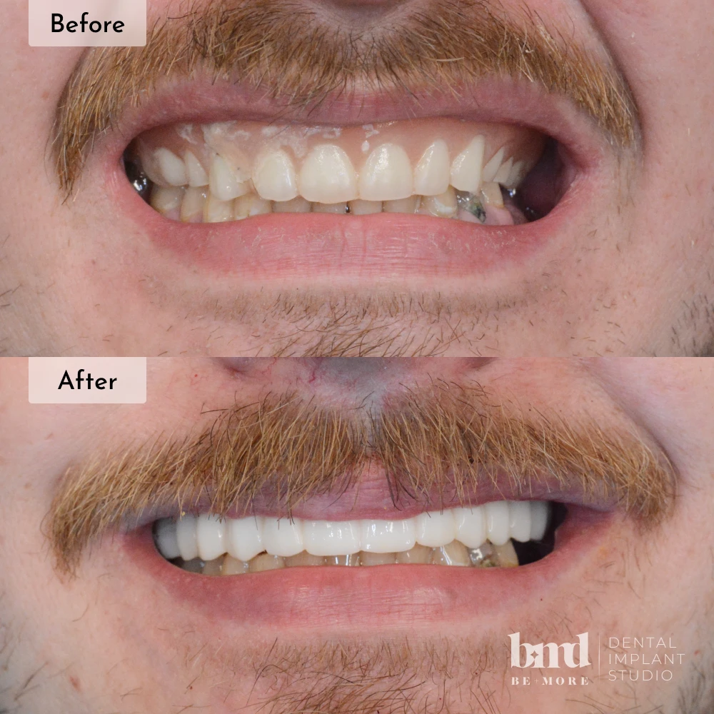 Before and after All-On-4 full mouth dental implants in Baltimore at Be More Dental Implant Studio